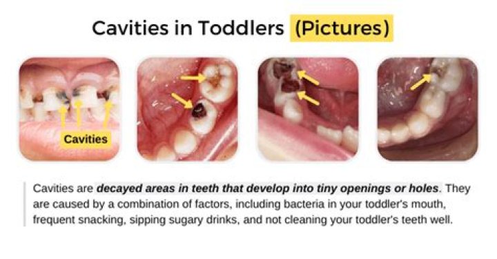 Are cavities common in 4 year olds?