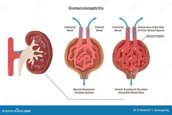 Are nephritis and nephropathy the same?