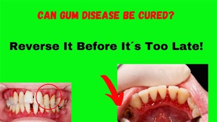 Can a gum disease be cured?