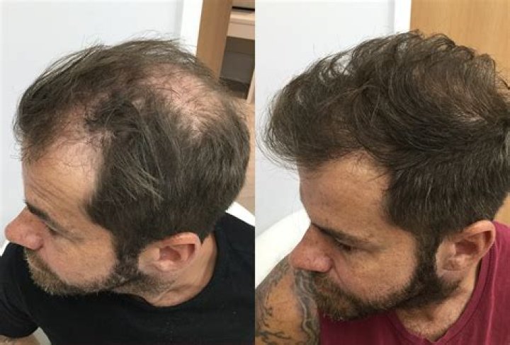 Can hair loss be covered by insurance?