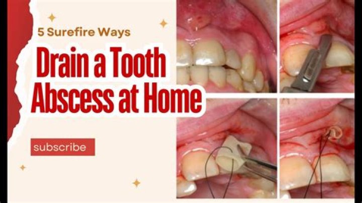 Can I get an abscess after tooth extraction?