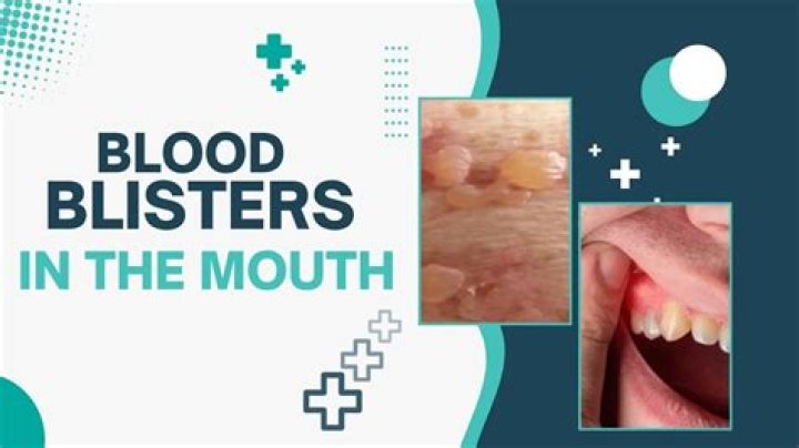 Can I pop blood blister in mouth?