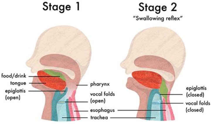Can osteophytes affect swallowing?