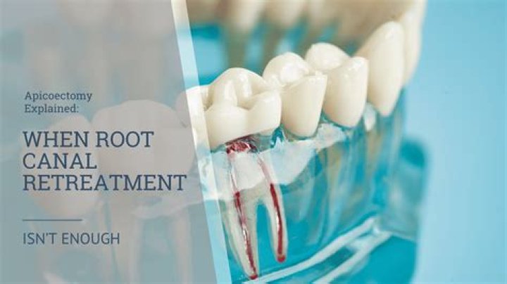 Can re root canal be done on NHS?