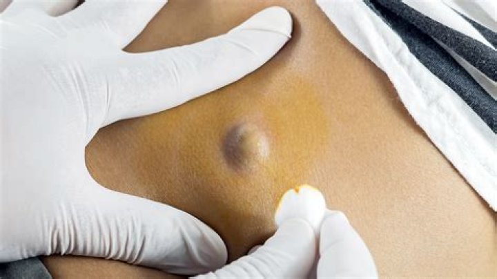 Can sebaceous hyperplasia be removed?