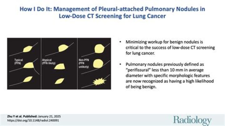 Does a Spiculated lung nodule always mean cancer?