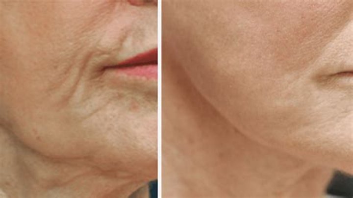 Does Viora skin tightening work?