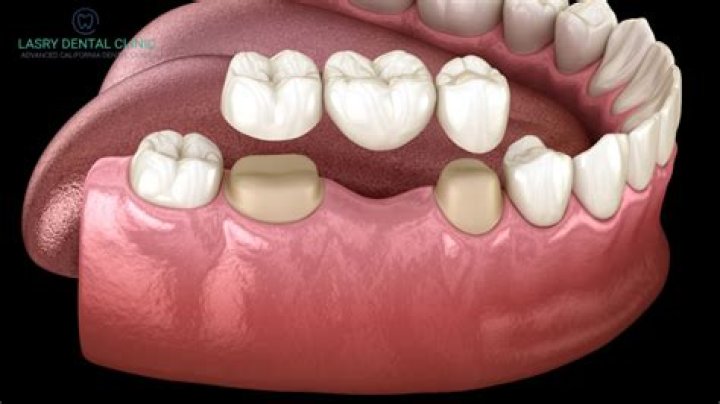How can you tell if a dental bridge is bad?