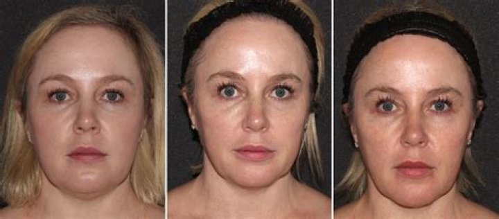 How do I fix my Portcls system?