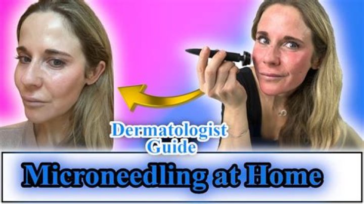 How do I prepare my face for microneedling?