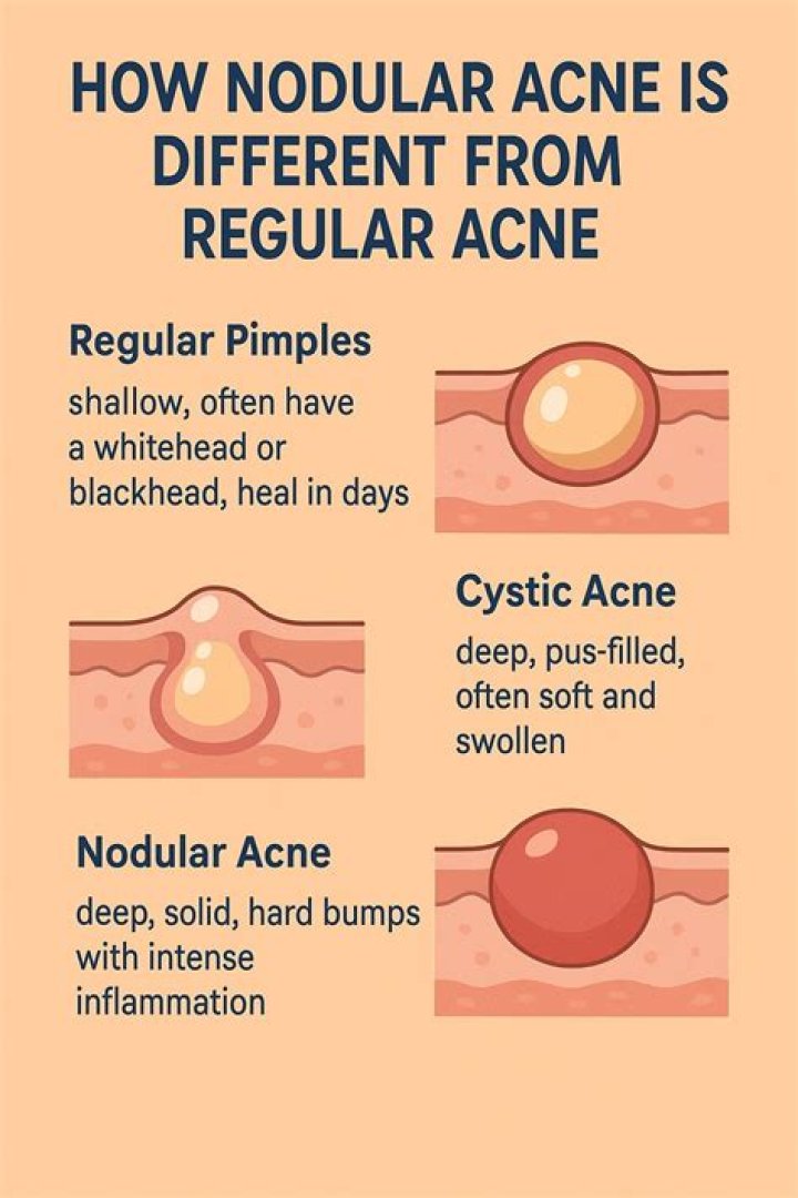 How do you calm down a nodular pimple?