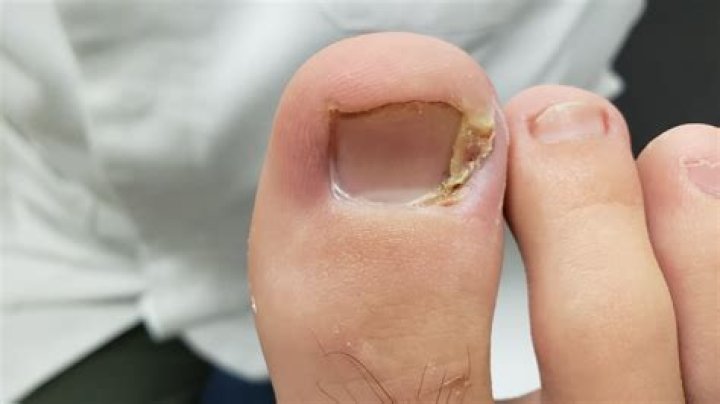 How do you get rid of skin growing on toenails?