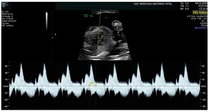 How do you measure PR interval in fetal echo?