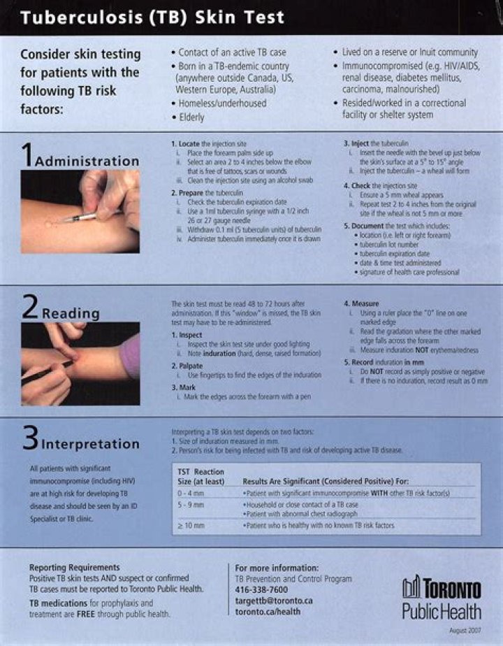How do you measure tuberculin skin test?