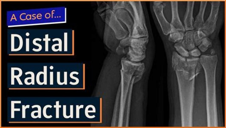 How do you rehab a distal radius fracture?