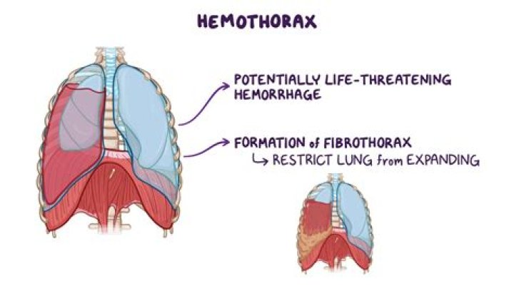 How do you treat a Hemothorax in the field?
