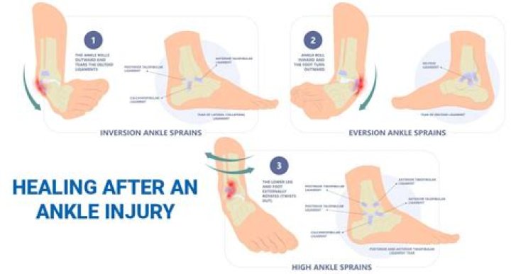 How do you treat an inverted ankle?