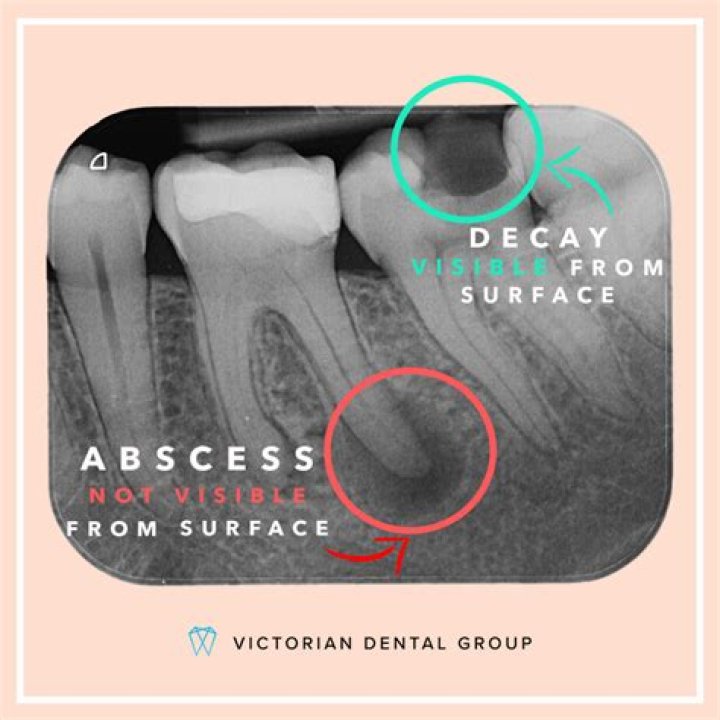 How is BCG abcess treated?