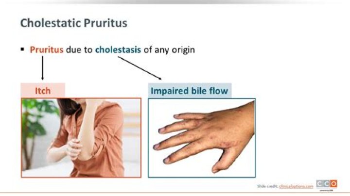 How is cholestatic pruritus treated?