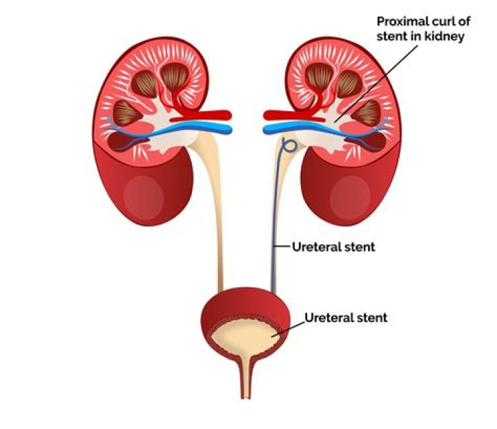 How long is a stent from kidney to bladder?
