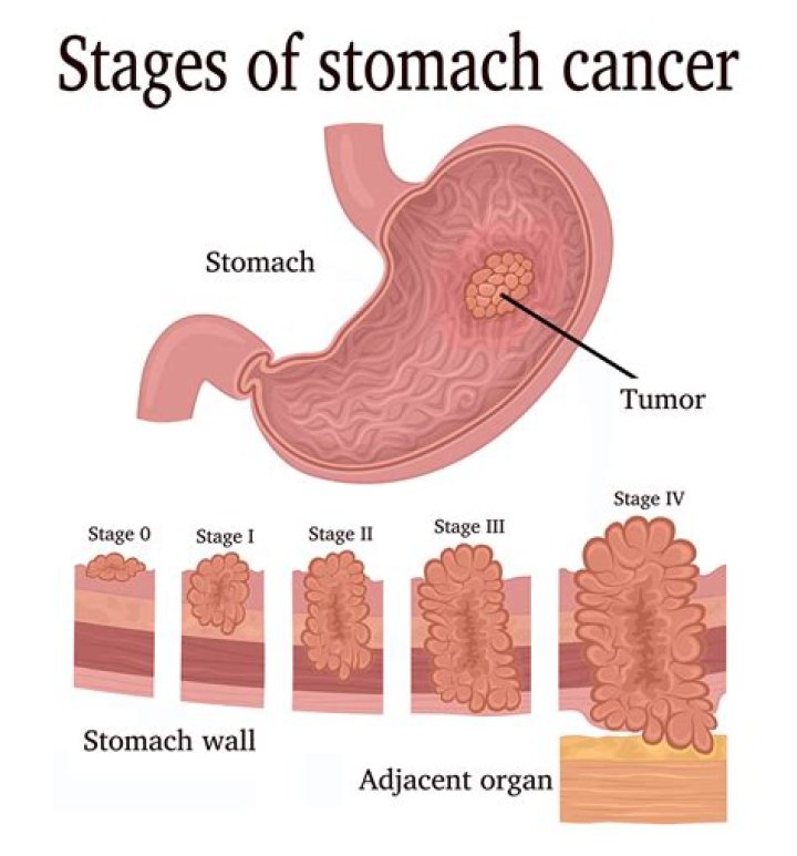 How many stages does adenocarcinoma have?
