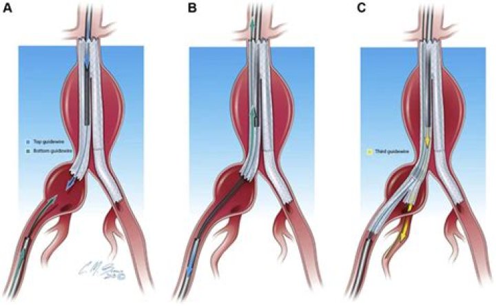 How risky is femoral artery surgery?