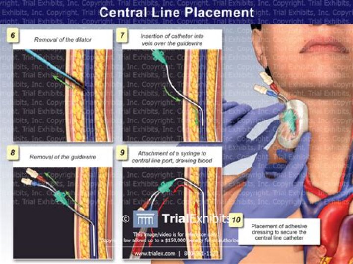 Is a Cordis considered a central line?