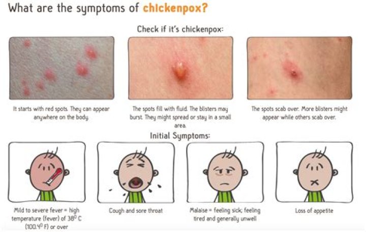 Is chickenpox deadly for babies?