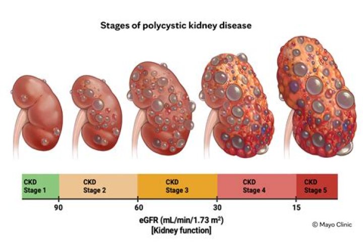 Is polycystic kidney disease serious?