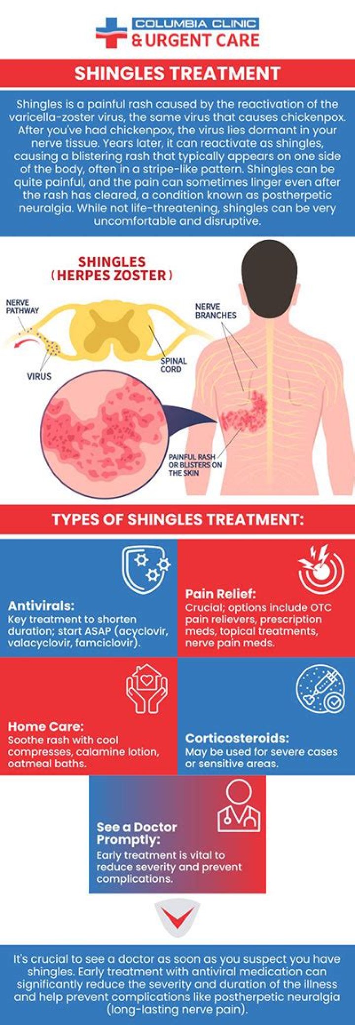 Is there anything OTC for shingles?