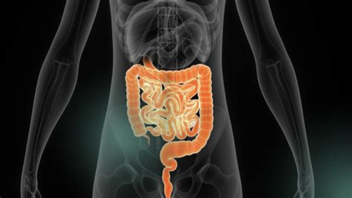 Que significa megacolon toxico?