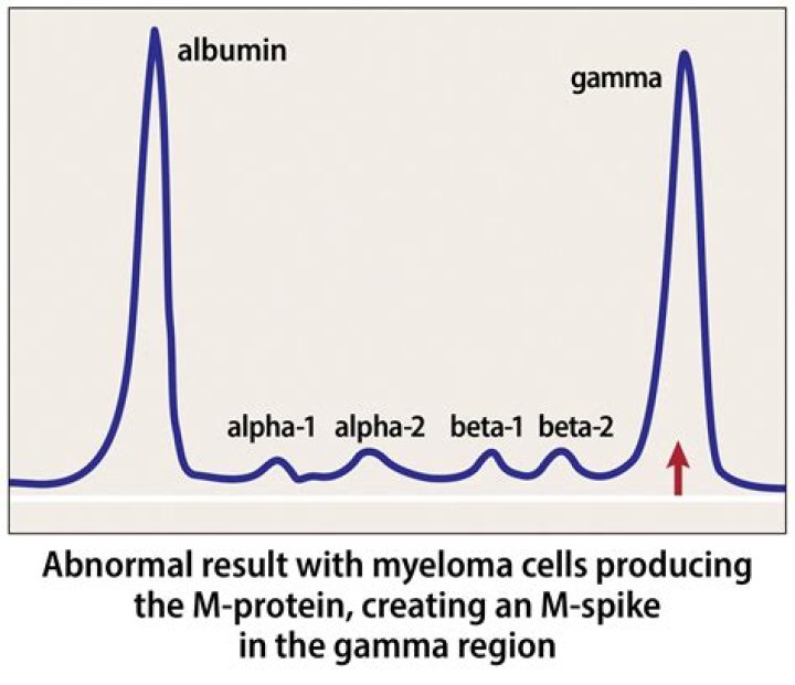 What age is the peak onset for multiple myeloma?