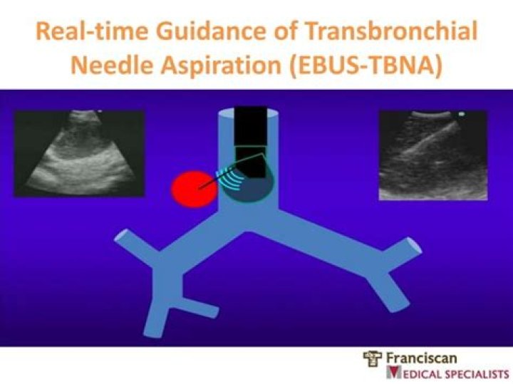 What are complications of an EBUS TBNA?