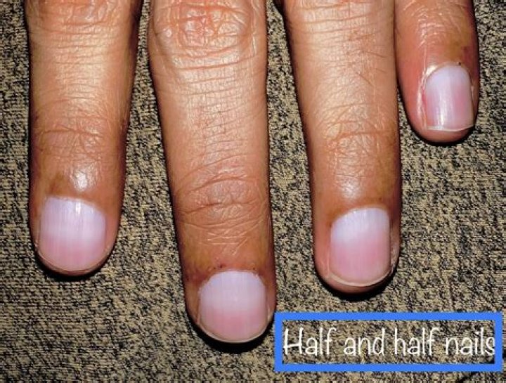 What are half and half nails?