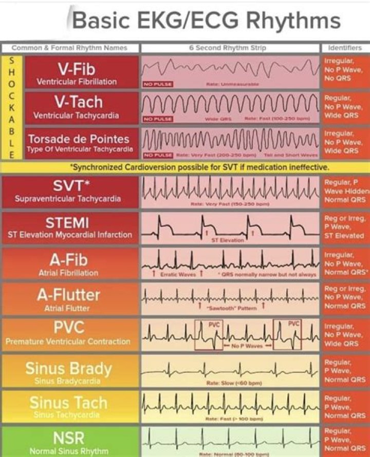 What are the lethal EKG rhythms?