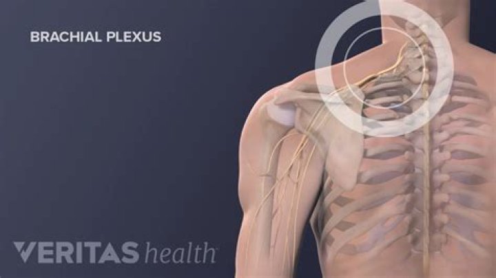 What are the symptoms of brachial neuritis?