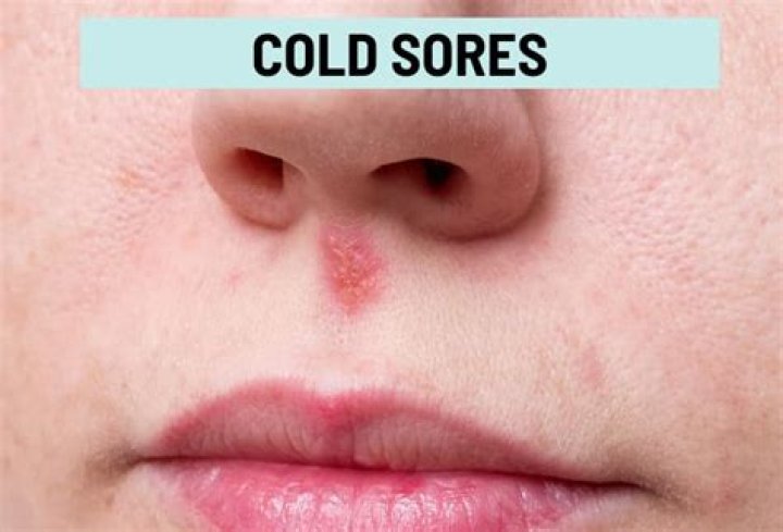 What causes cold sores in your nose?