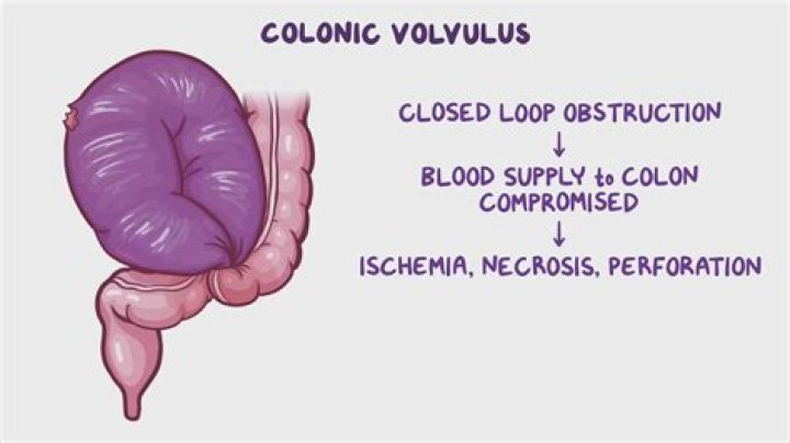 What causes colonic Pneumatosis?
