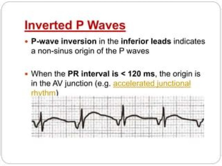 What causes inverted P waves on ECG?
