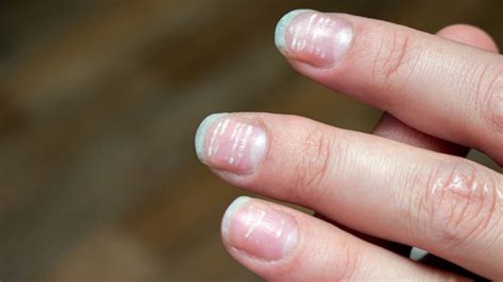 What deficiency causes white lines on nails?