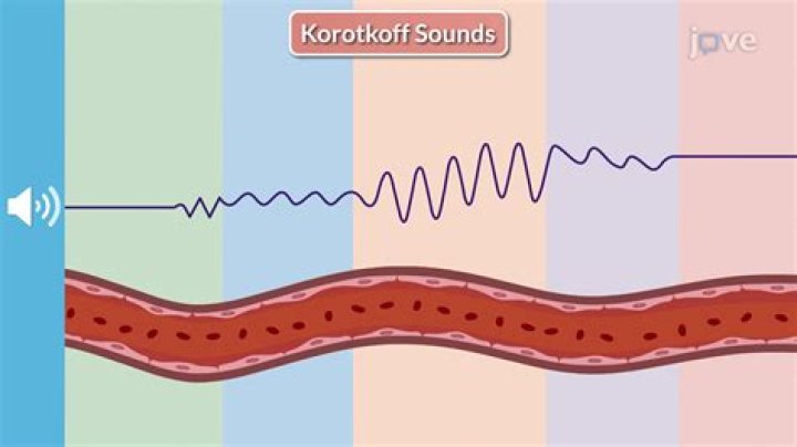 What do the korotkoff sounds represent?