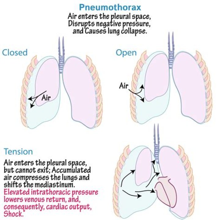 What does a pneumothorax sound like?