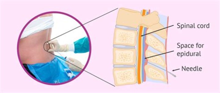 What does epidural pain feel like?