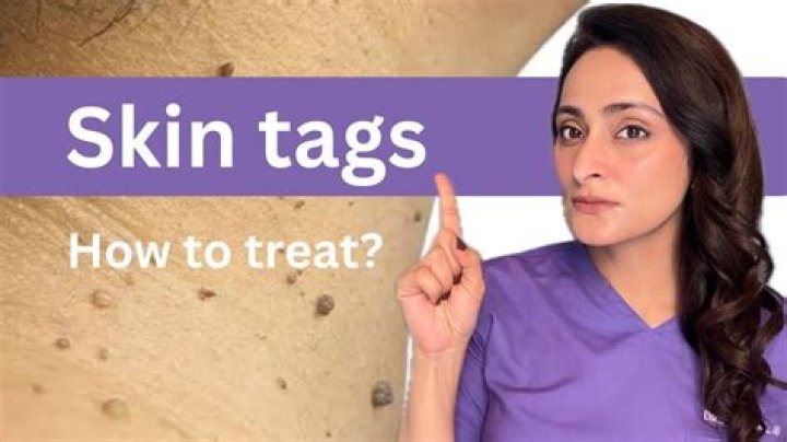 What does it mean when a skin tag turns purple?