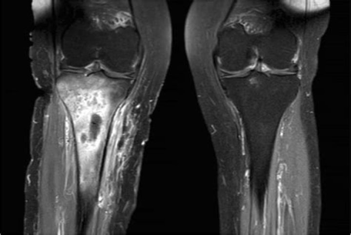 What does osteomyelitis look like on MRI?