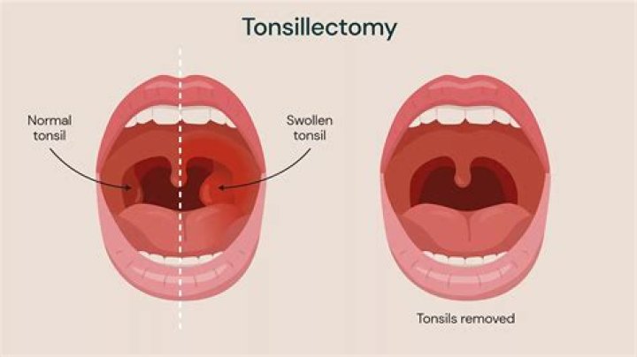 What happens when the scabs come off after tonsillectomy?