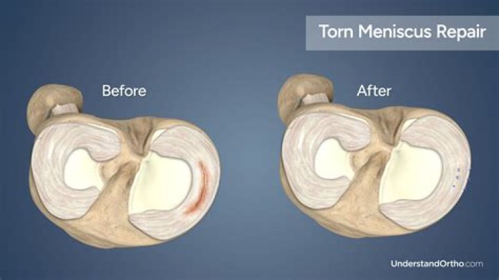 What if meniscus Cannot be repaired?