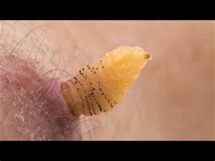 What insect lays eggs in human skin?
