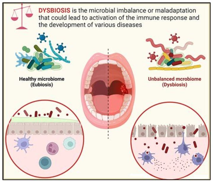What is bacterial dysbiosis?