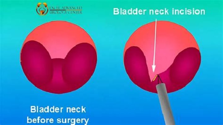 What is bladder neck incision?